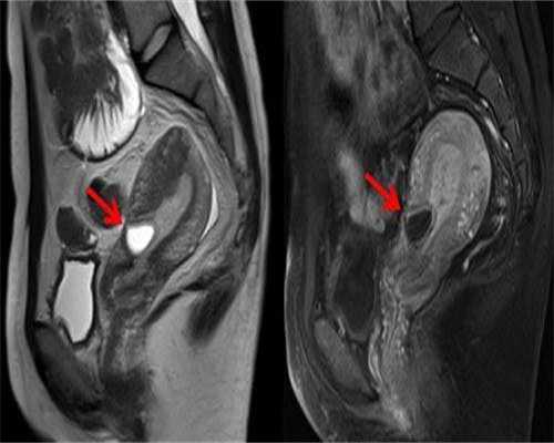 月经期间可以做核磁共振吗 做核磁共振一定要注意这些