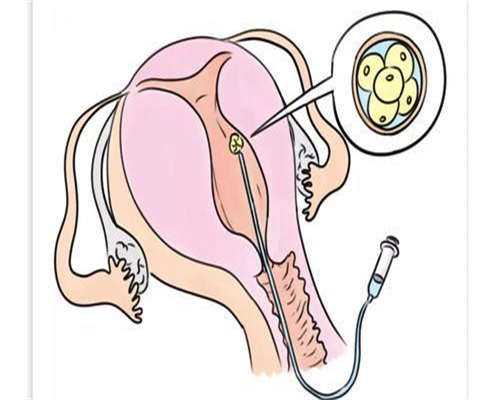 代孕套餐介绍:试管婴儿属于辅助生育技术吗