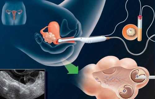 代生包儿子:卵巢早衰会不会怀孕？卵巢早衰还能有机会怀孕