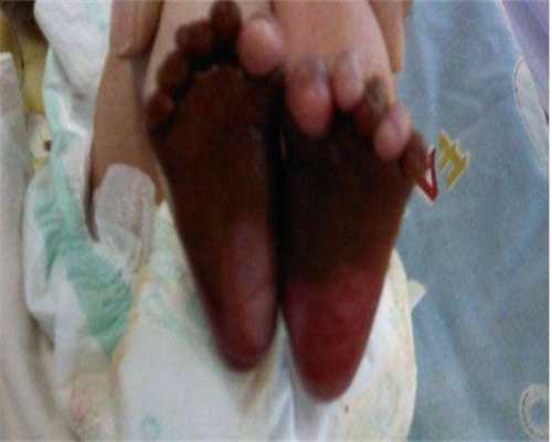 宫外孕保守治疗三天后HCG反而升了